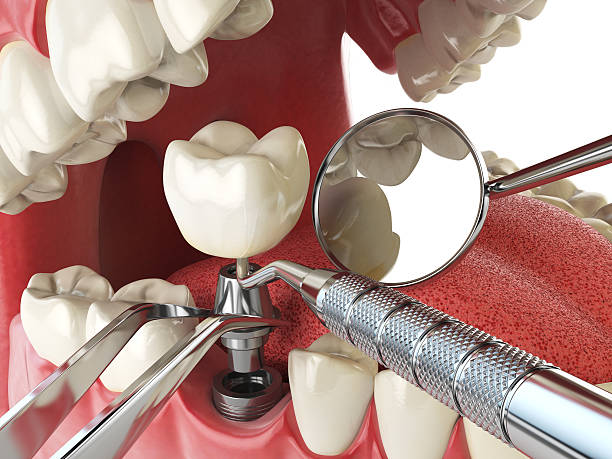 Best Emergency Broken Tooth Repair in West Clarkston Highland, WA